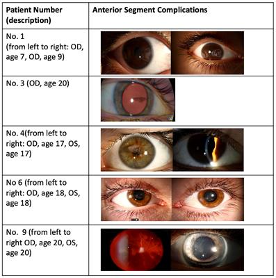 Delayed anterior segment complications after the treatment of retinopathy of prematurity with laser photocoagulation